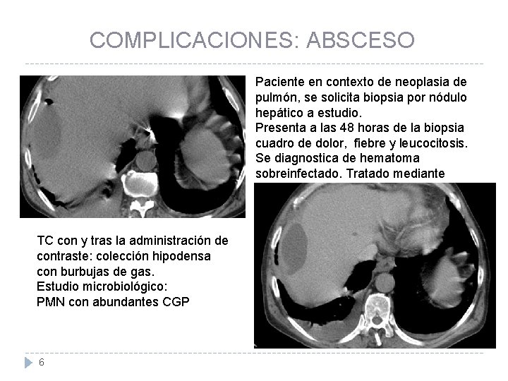 COMPLICACIONES: ABSCESO Paciente en contexto de neoplasia de pulmón, se solicita biopsia por nódulo
