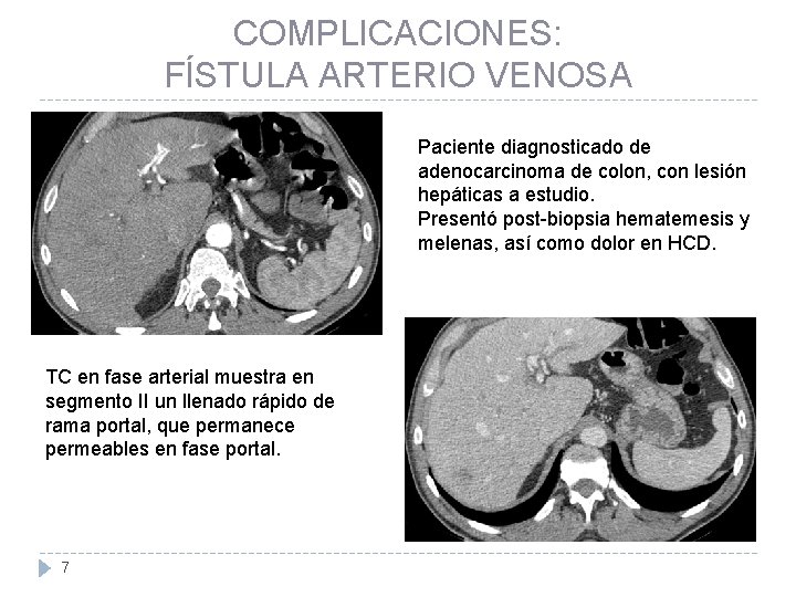 COMPLICACIONES: FÍSTULA ARTERIO VENOSA Paciente diagnosticado de adenocarcinoma de colon, con lesión hepáticas a