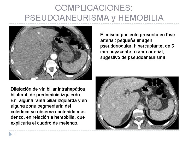 COMPLICACIONES: PSEUDOANEURISMA y HEMOBILIA El mismo paciente presentó en fase arterial: pequeña imagen pseudonodular,