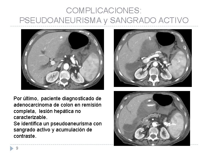 COMPLICACIONES: PSEUDOANEURISMA y SANGRADO ACTIVO Por último, paciente diagnosticado de adenocarcinoma de colon en