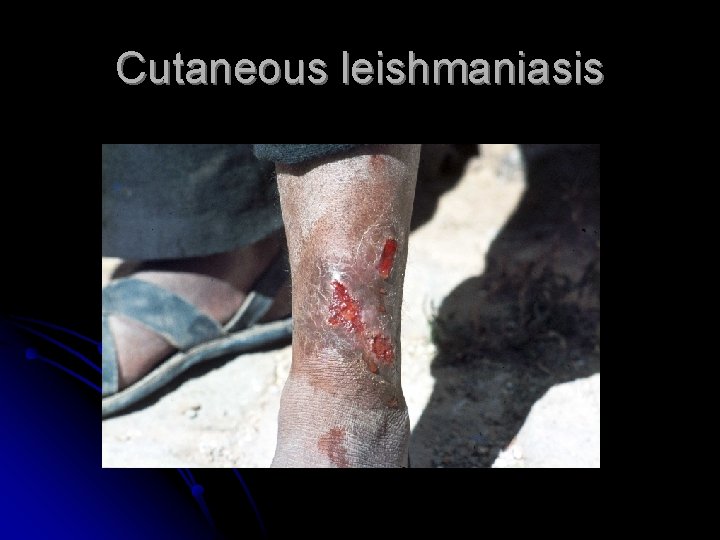Cutaneous leishmaniasis 