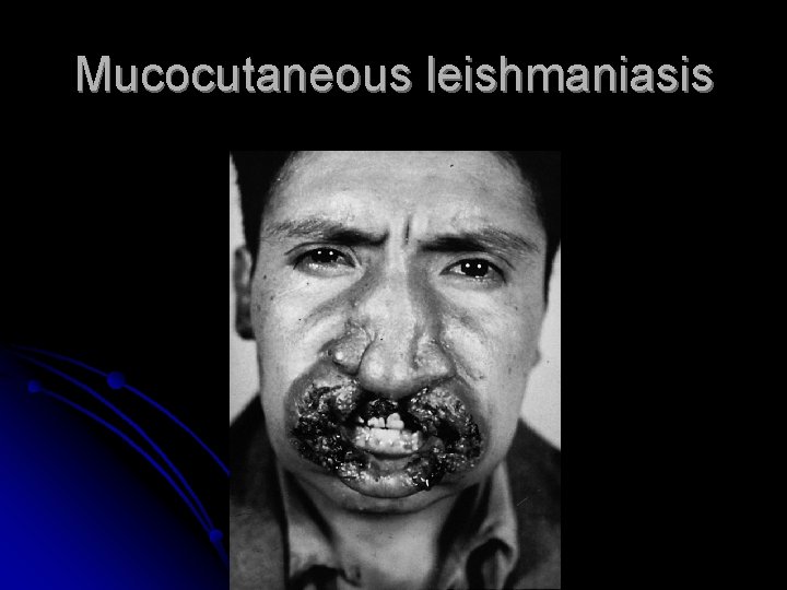 Mucocutaneous leishmaniasis 
