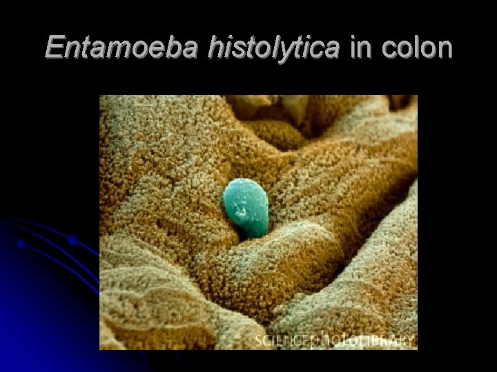Entamoeba histolytica in colon 