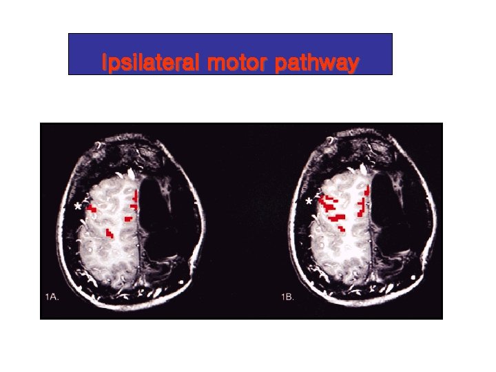 Ipsilateral motor pathway 