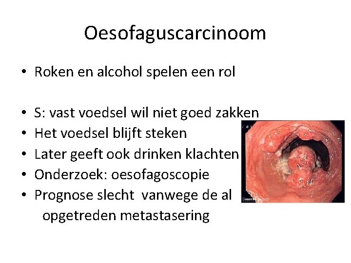 Oesofaguscarcinoom • Roken en alcohol spelen een rol • • • S: vast voedsel