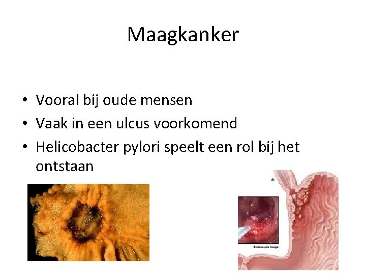 Maagkanker • Vooral bij oude mensen • Vaak in een ulcus voorkomend • Helicobacter