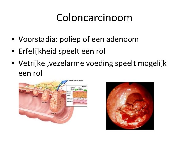 Coloncarcinoom • Voorstadia: poliep of een adenoom • Erfelijkheid speelt een rol • Vetrijke