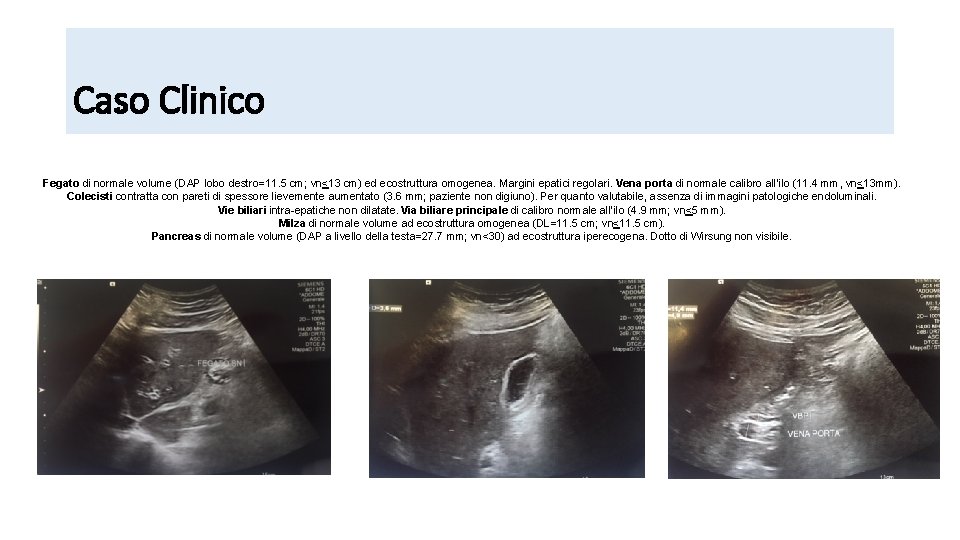 Caso Clinico Fegato di normale volume (DAP lobo destro=11. 5 cm; vn<13 cm) ed