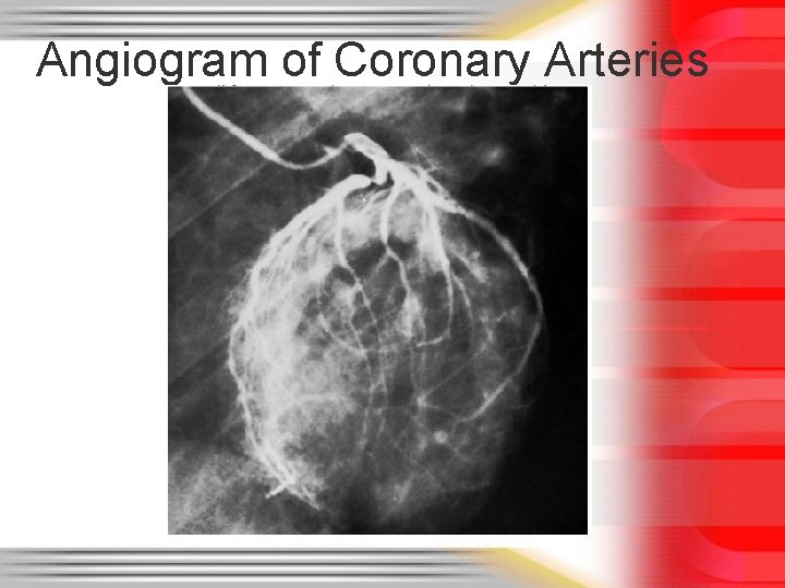 Angiogram of Coronary Arteries 