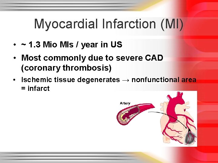 Myocardial Infarction (MI) • ~ 1. 3 Mio MIs / year in US •