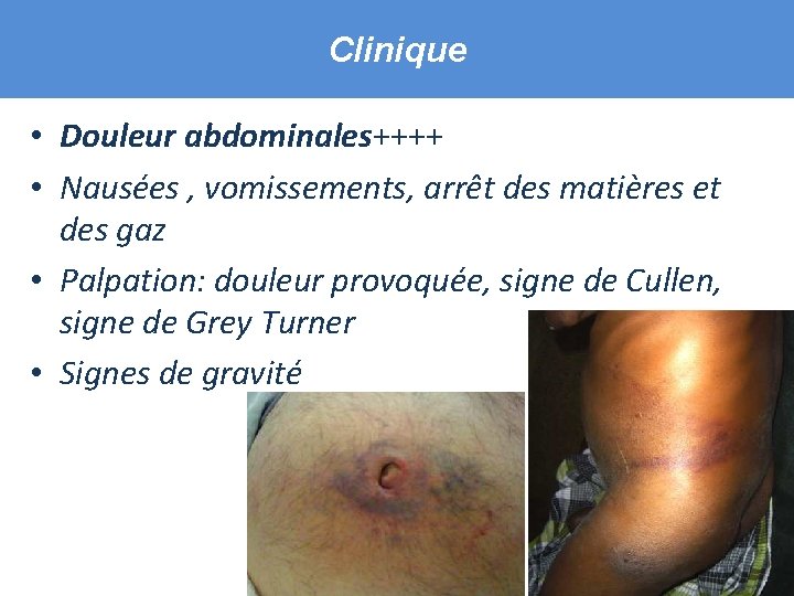 Clinique • Douleur abdominales++++ • Nausées , vomissements, arrêt des matières et des gaz