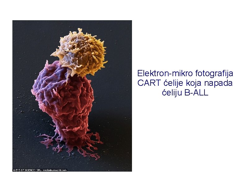 Elektron-mikro fotografija CART ćelije koja napada ćeliju B-ALL 