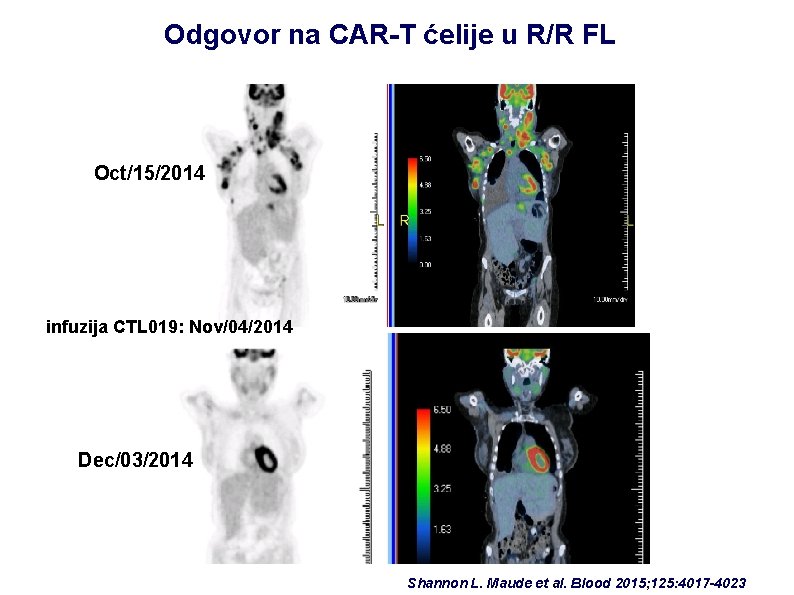 Odgovor na CAR-T ćelije u R/R FL Oct/15/2014 infuzija CTL 019: Nov/04/2014 Dec/03/2014 Shannon