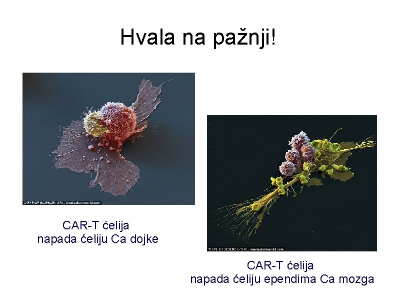 Hvala na pažnji! CAR-T ćelija napada ćeliju Ca dojke CAR-T ćelija napada ćeliju ependima