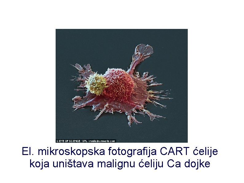 El. mikroskopska fotografija CART ćelije koja uništava malignu ćeliju Ca dojke 