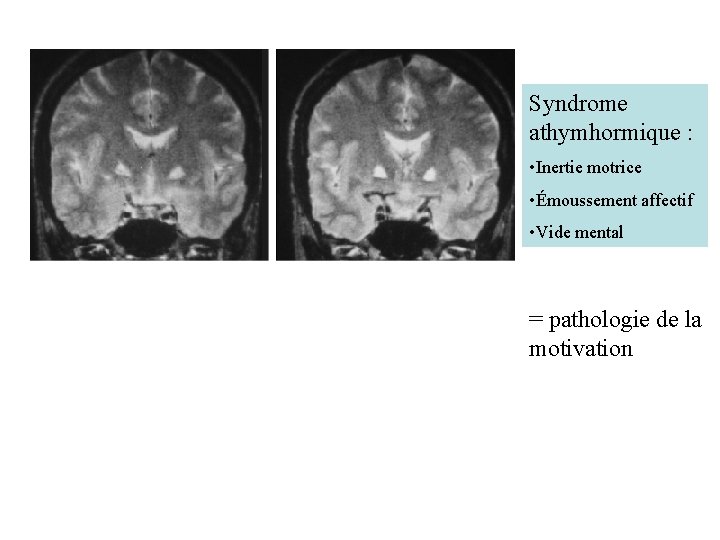 Syndrome athymhormique : • Inertie motrice • Émoussement affectif • Vide mental = pathologie