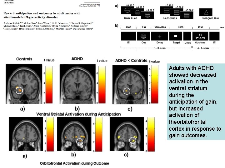 Adults with ADHD showed decreased activation in the ventral striatum during the anticipation of