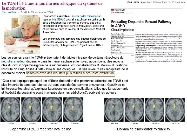 Dopamine D 2/D 3 receptor availability Dopamine transporter availability 