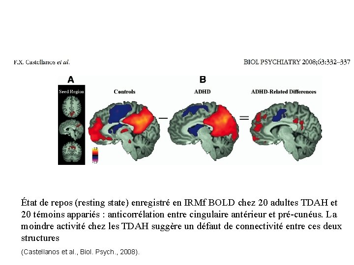 État de repos (resting state) enregistré en IRMf BOLD chez 20 adultes TDAH et