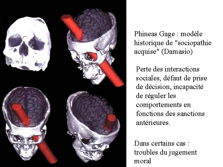Phineas Gage : modèle historique de "sociopathie acquise" (Damasio) Perte des interactions sociales, défaut