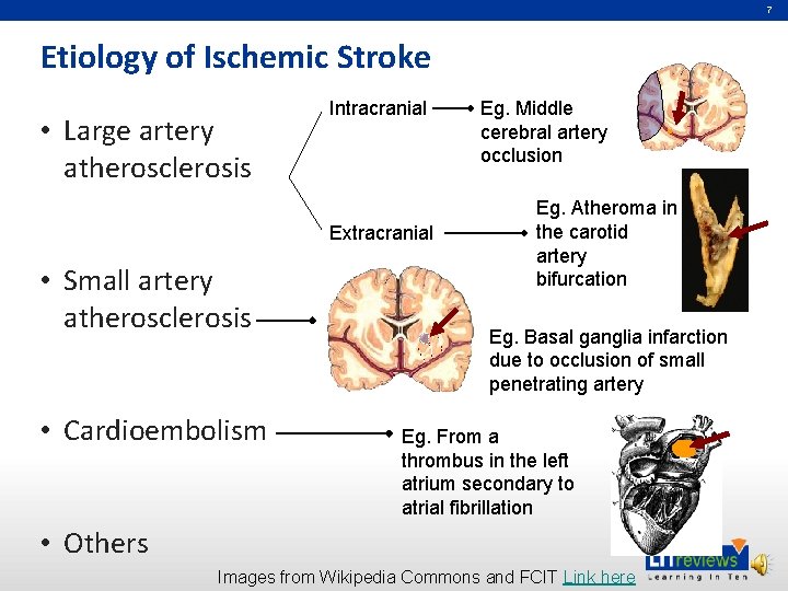 7 Etiology of Ischemic Stroke • Large artery atherosclerosis Intracranial Extracranial • Small artery