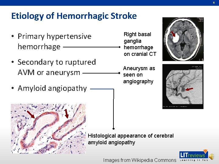 8 Etiology of Hemorrhagic Stroke • Primary hypertensive hemorrhage • Secondary to ruptured AVM