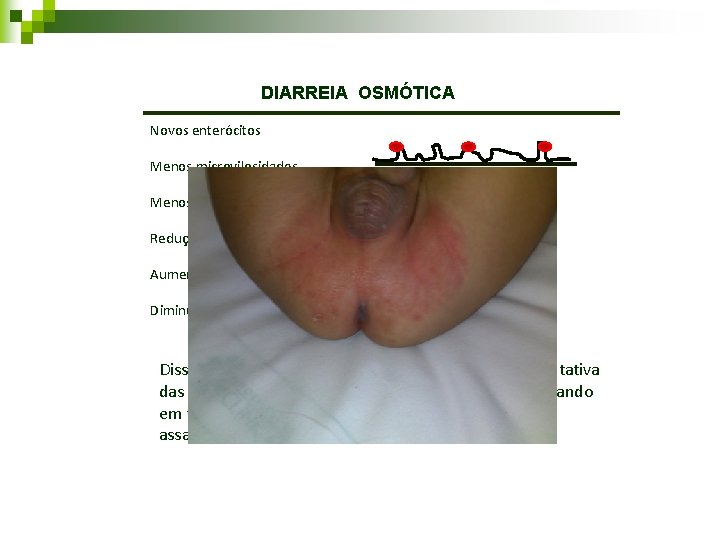DIARREIA OSMÓTICA Novos enterócitos Menos microvilosidades Menos absorção Redução da atividade da bomba Na/K DIARREIA OSMÓTICA Novos enterócitos Menos microvilosidades Menos absorção Redução da atividade da bomba Na/K