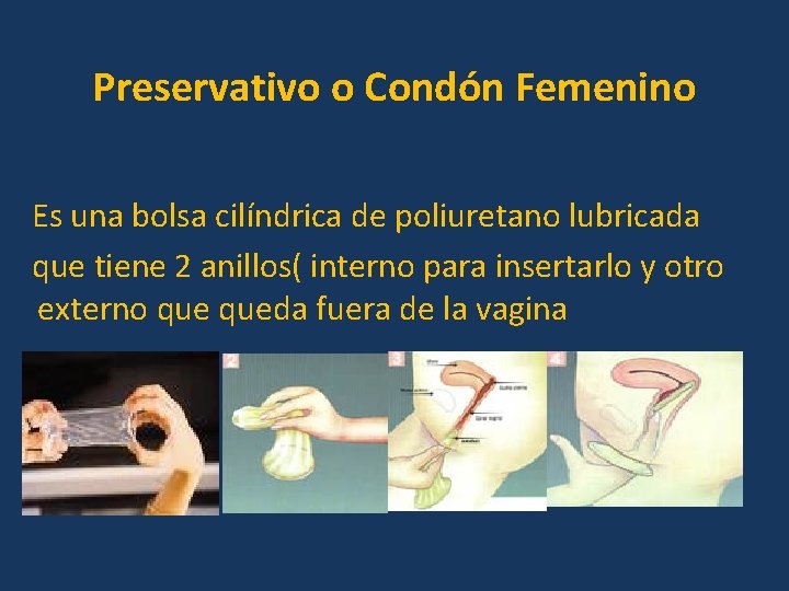 Preservativo o Condón Femenino Es una bolsa cilíndrica de poliuretano lubricada que tiene 2