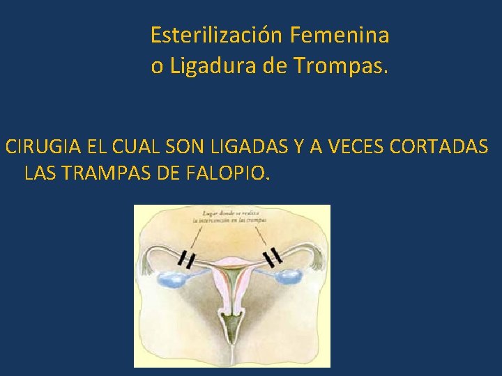 Esterilización Femenina o Ligadura de Trompas. CIRUGIA EL CUAL SON LIGADAS Y A VECES