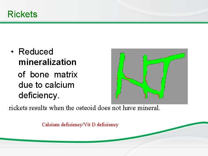 Rickets • Reduced mineralization of bone matrix due to calcium deficiency. rickets results when