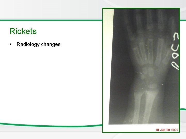 Newborn Screening Rickets • Radiology changes 