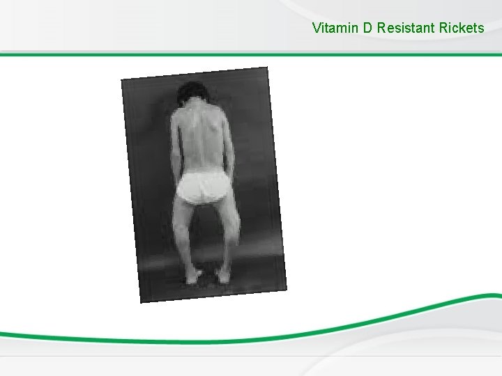 Vitamin D Resistant Rickets 