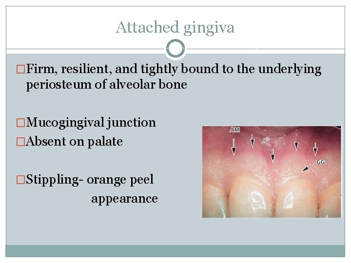 Attached gingiva �Firm, resilient, and tightly bound to the underlying periosteum of alveolar bone