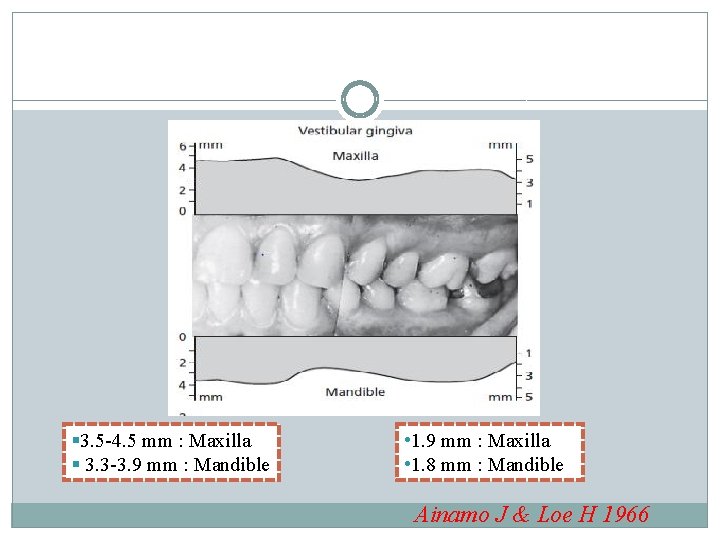 § 3. 5 -4. 5 mm : Maxilla § 3. 3 -3. 9 mm