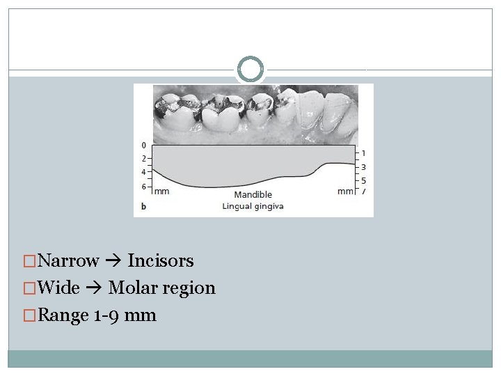 �Narrow Incisors �Wide Molar region �Range 1 -9 mm 
