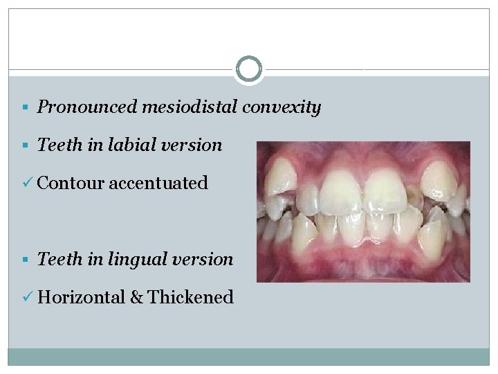 § Pronounced mesiodistal convexity § Teeth in labial version ü Contour accentuated § Teeth