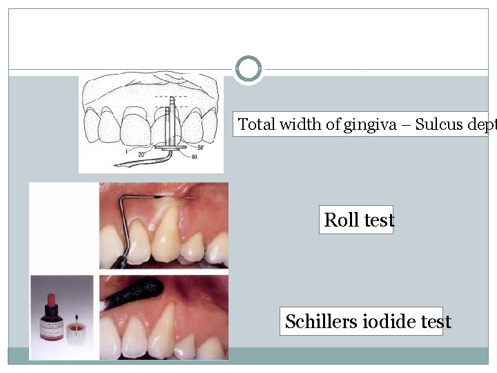 Total width of gingiva – Sulcus dept Roll test Schillers iodide test 