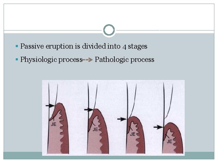 § Passive eruption is divided into 4 stages § Physiologic process Pathologic process 