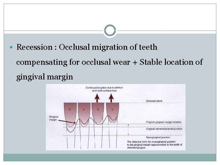 § Recession : Occlusal migration of teeth compensating for occlusal wear + Stable location