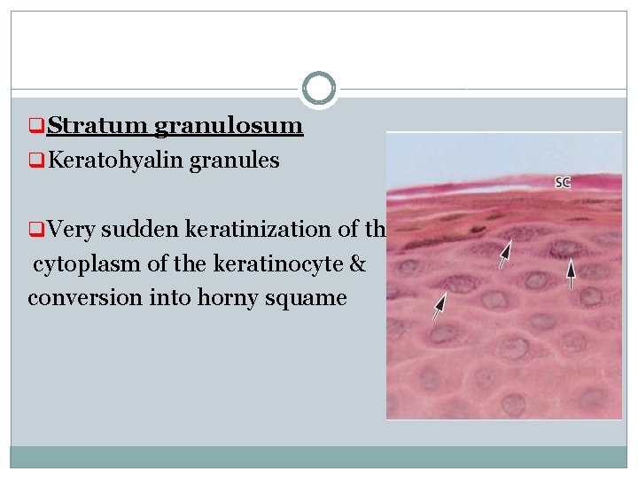 q Stratum granulosum q Keratohyalin granules q Very sudden keratinization of the cytoplasm of