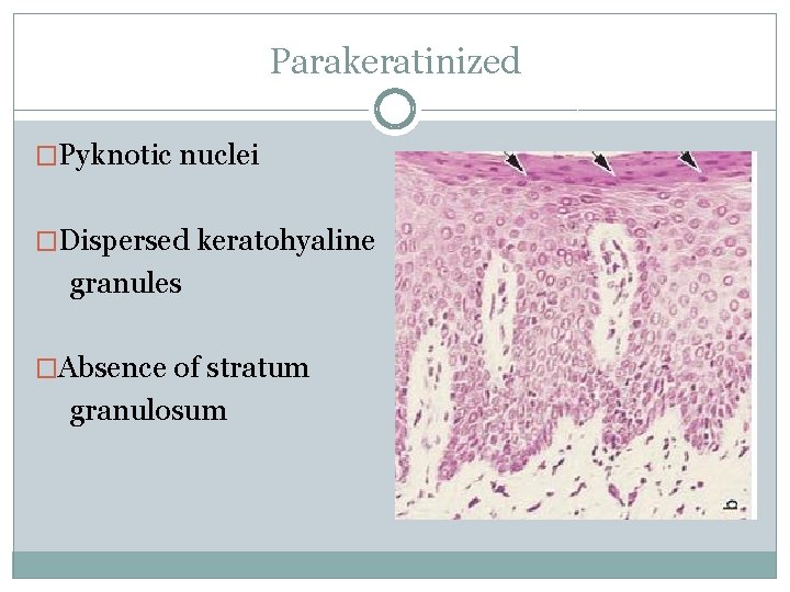 Parakeratinized �Pyknotic nuclei �Dispersed keratohyaline granules �Absence of stratum granulosum 