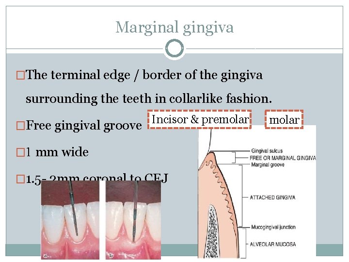 Marginal gingiva �The terminal edge / border of the gingiva surrounding the teeth in