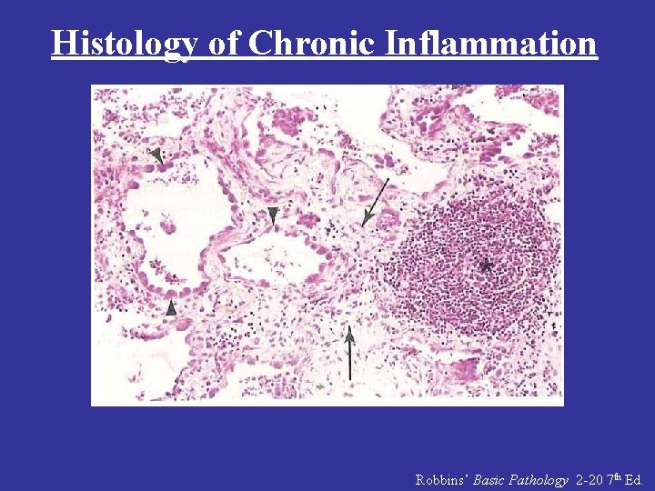 Histology of Chronic Inflammation Robbins’ Basic Pathology 2 -20 7 th Ed. 