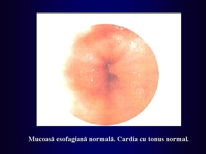 Mucoasă esofagiană normală. Cardia cu tonus normal. 