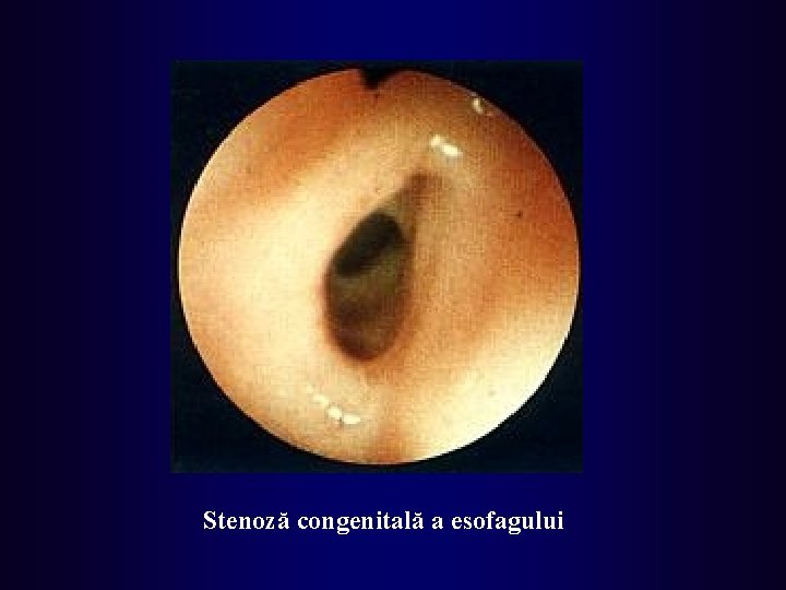 Stenoză congenitală a esofagului 