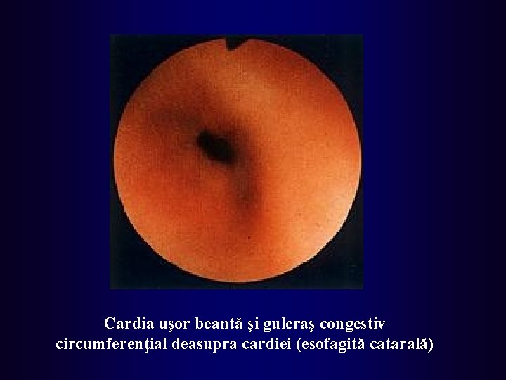 Cardia uşor beantă şi guleraş congestiv circumferenţial deasupra cardiei (esofagită catarală) 