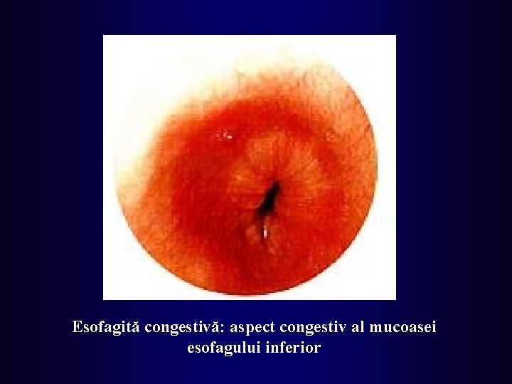 Esofagită congestivă: aspect congestiv al mucoasei esofagului inferior 