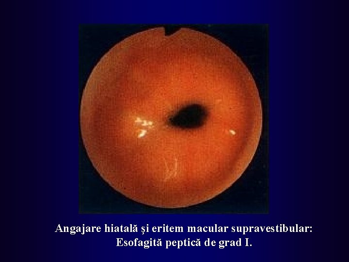 Angajare hiatală şi eritem macular supravestibular: Esofagită peptică de grad I. 