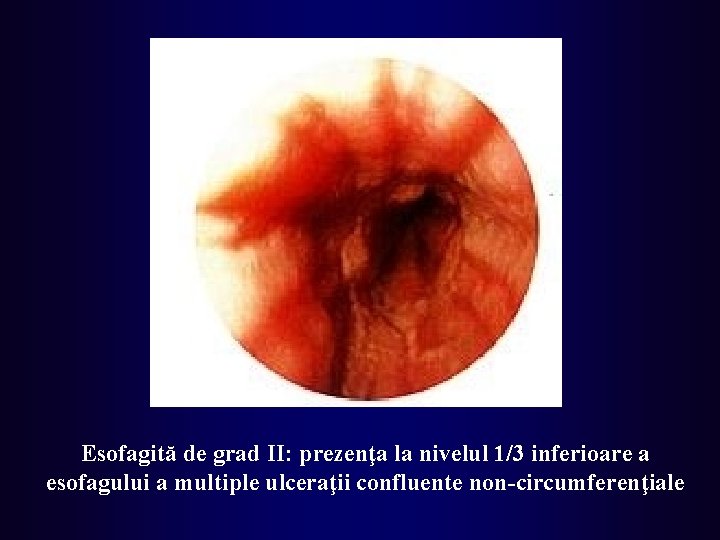 Esofagită de grad II: prezenţa la nivelul 1/3 inferioare a esofagului a multiple ulceraţii