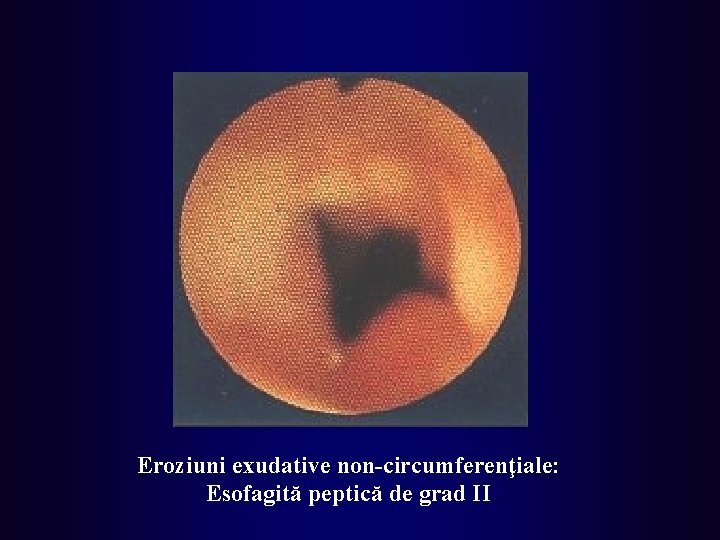 Eroziuni exudative non-circumferenţiale: Esofagită peptică de grad II 